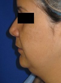 Chin Liposuction Before & After Patient #8345