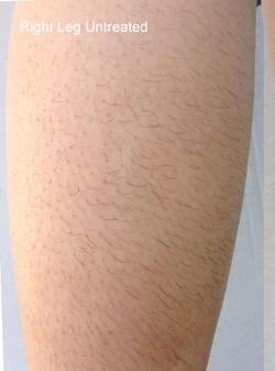 Diolaze Before & After Patient #11669
