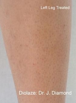 Diolaze Before & After Patient #11669