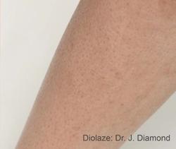 Diolaze Before & After Patient #11670