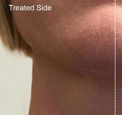Forma Before & After Patient #11676