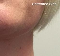 Forma Before & After Patient #11676