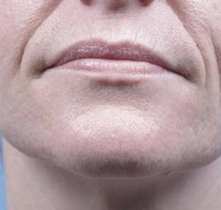 Forma Before & After Patient #11677