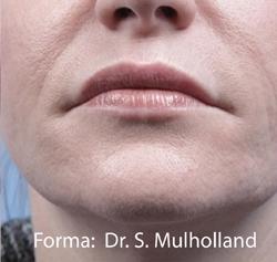 Forma Before & After Patient #11677