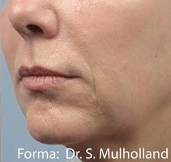 Forma Before & After Patient #11678
