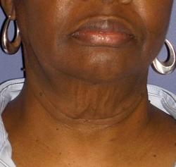 Forma Before & After Patient #11679