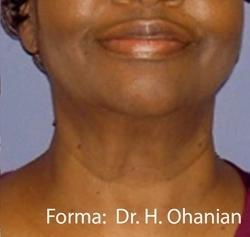 Forma Before & After Patient #11679