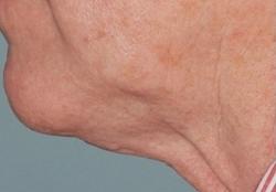 Forma Before & After Patient #11680