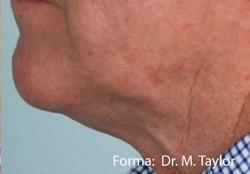 Forma Before & After Patient #11680