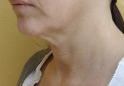 Forma Before & After Patient #11682