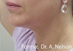 Forma Before & After Patient #11682