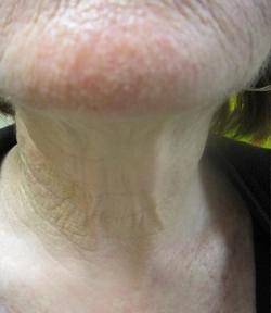 Fractora Before & After Patient #11695