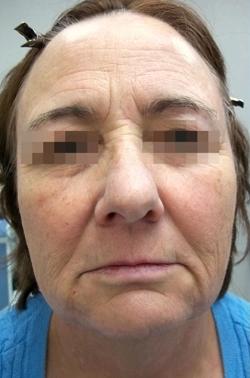 Fractora Before & After Patient #11696