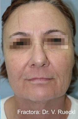 Fractora Before & After Patient #11696