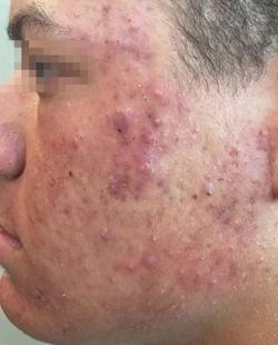 Fractora Before & After Patient #11697