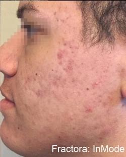 Fractora Before & After Patient #11697