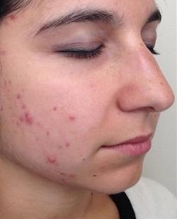 Fractora Before & After Patient #11699