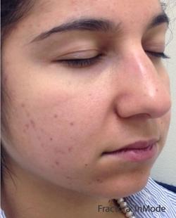 Fractora Before & After Patient #11699