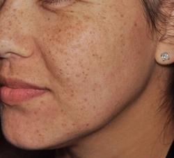 Lumecca Before & After Patient #11711