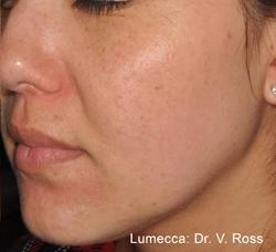 Lumecca Before & After Patient #11711