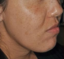 Lumecca Before & After Patient #11712