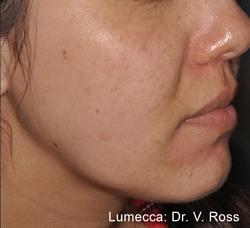 Lumecca Before & After Patient #11712