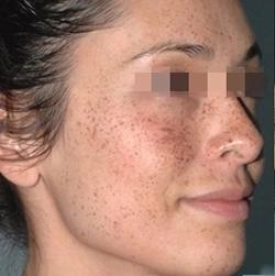 Lumecca Before & After Patient #11713