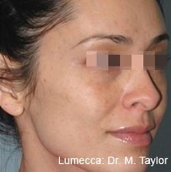 Lumecca Before & After Patient #11713