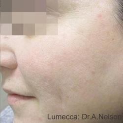 Lumecca Before & After Patient #11714