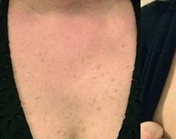 Lumecca Before & After Patient #11715