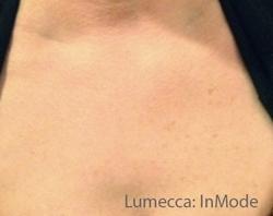 Lumecca Before & After Patient #11715