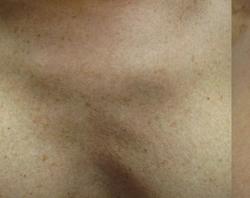 Lumecca Before & After Patient #11717