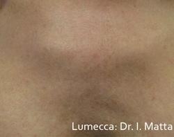 Lumecca Before & After Patient #11717