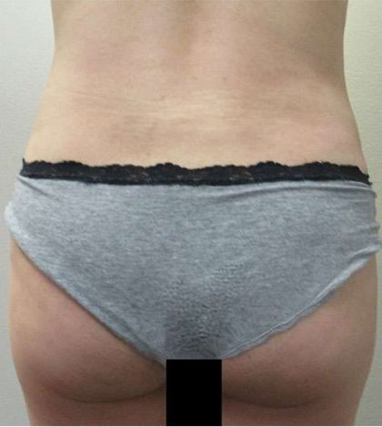 Liposuction Revision Before & After Patient #9555