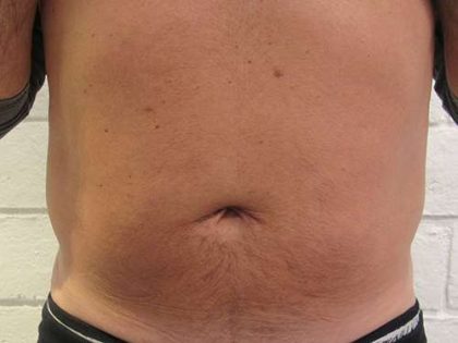 Liposuction Revision Cellulite Reduction Before & After Patient #9580