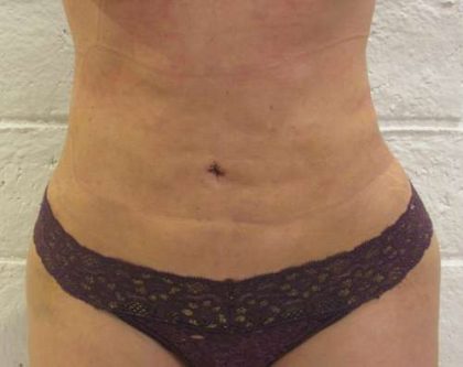 Liposuction Revision Cellulite Reduction Before & After Patient #9619