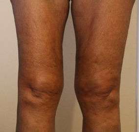 Liposuction Revision Before & After Patient #9622