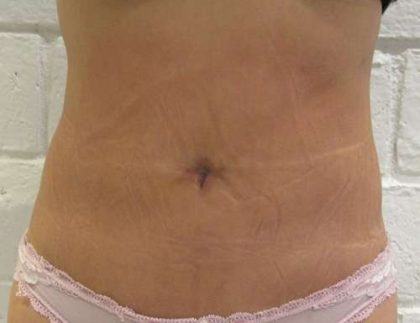 Liposuction Revision Cellulite Reduction Before & After Patient #9628