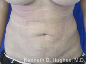 Liposuction Revision Cellulite Reduction Before & After Patient #9658