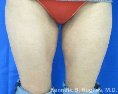 Liposuction Revision Cellulite Reduction Before & After Patient #9661
