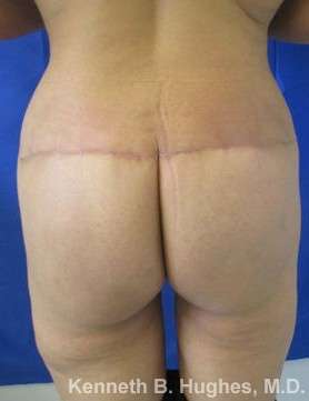 Liposuction Revision Cellulite Reduction Before & After Patient #9669