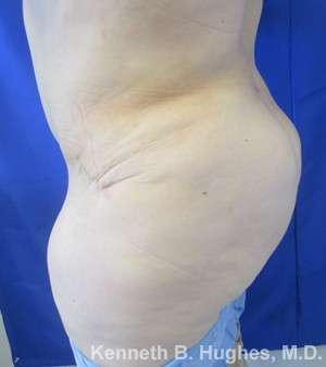 Brazilian Butt Lift Before & After Patient #6276