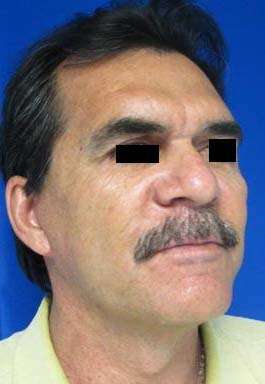 Male Brow Lift Before & After Patient #9679