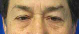 Male Eyelid Surgery Before & After Patient #9682