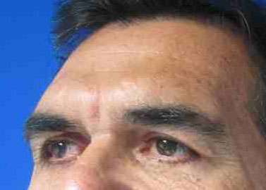 Male Eyelid Surgery Before & After Patient #9685