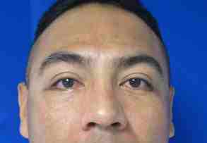 Male Eyelid Surgery Before & After Patient #9688