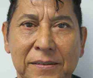 Male Eyelid Surgery Before & After Patient #9691