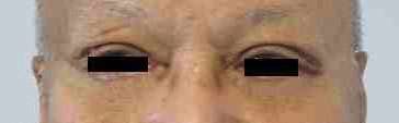 Male Eyelid Surgery Before & After Patient #9694