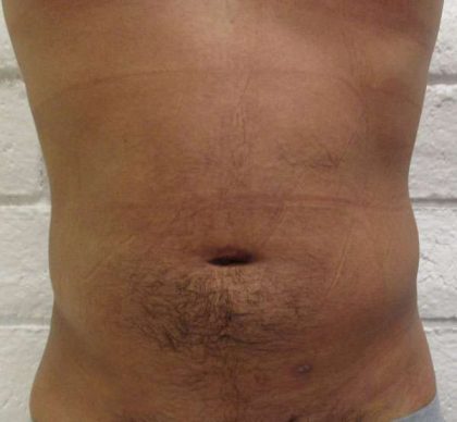 Male Liposuction Before & After Patient #9712