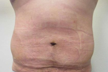 Male Liposuction Before & After Patient #9715